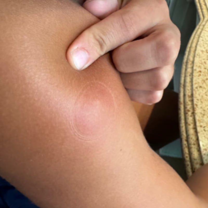 Close up on a bug bite on the arm after using the suction tool