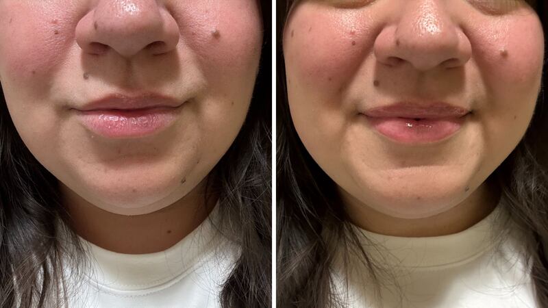 a before and after showing flakey dry lips and glossy plump lips