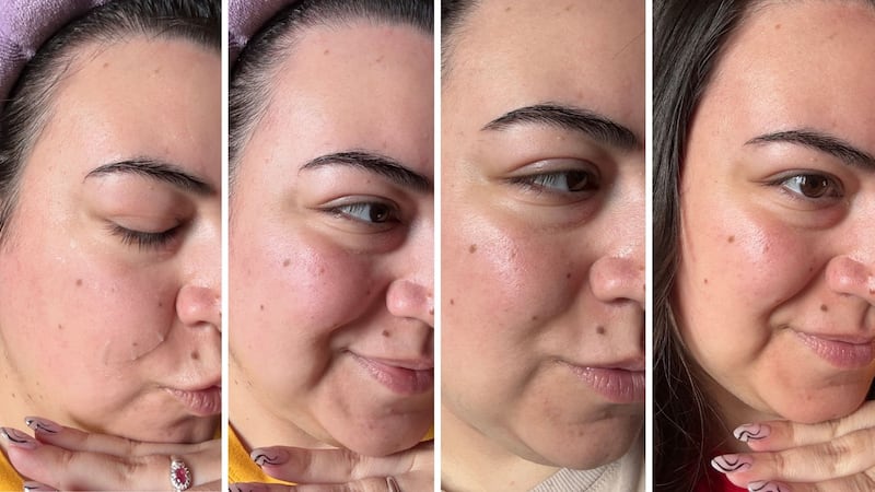 Four photos showing the progression of Bianca's skin while using the toner pads