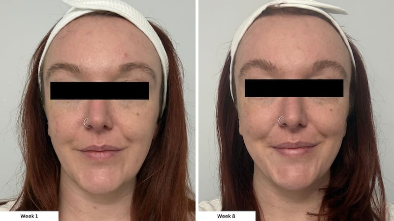 Meg's skin one week into using the mask, and eight weeks into using the mask.