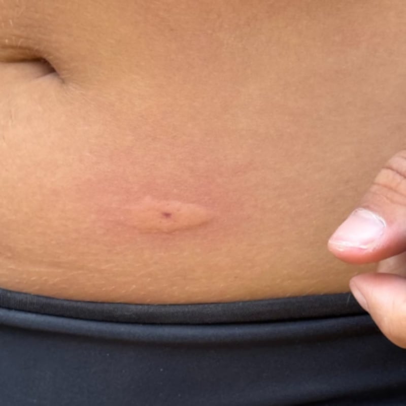 Close up on a mosquito bite on the stomach before treatment