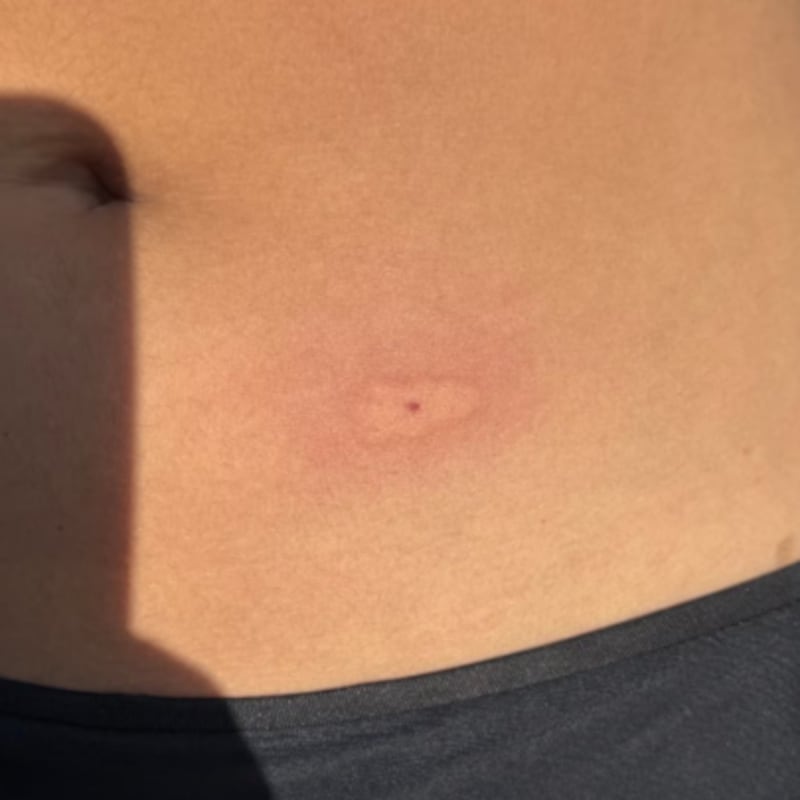 Close up on a mosquito bite on the stomach after treatment