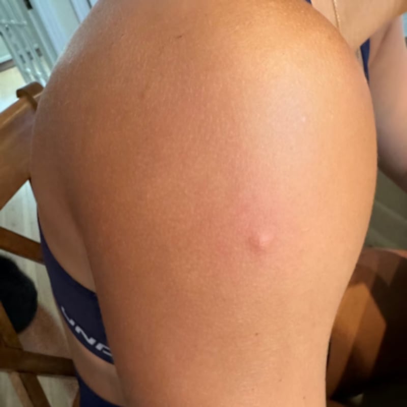Close up on a bug bite on the arm